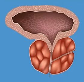 Characteristic signs of prostatitis