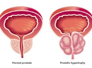 Normal and swollen prostate