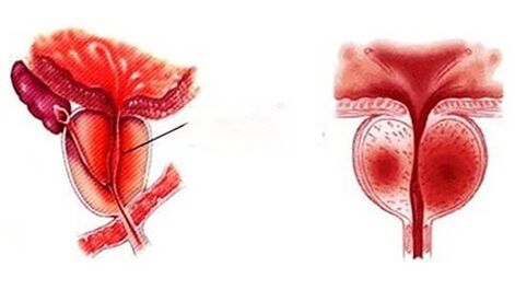 How do you see chronic prostatitis